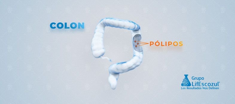Cáncer de colon